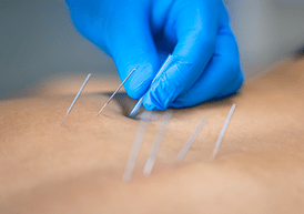 Dry Needling